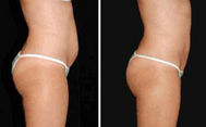 Lipo 다이오드 레이저 진공 RF 기계 제어 납품을 체중을 줄이는 초음파 지방 흡입 수술 공동현상